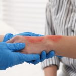 Long-Term Treatment Considerations for Patients with Severe Burns